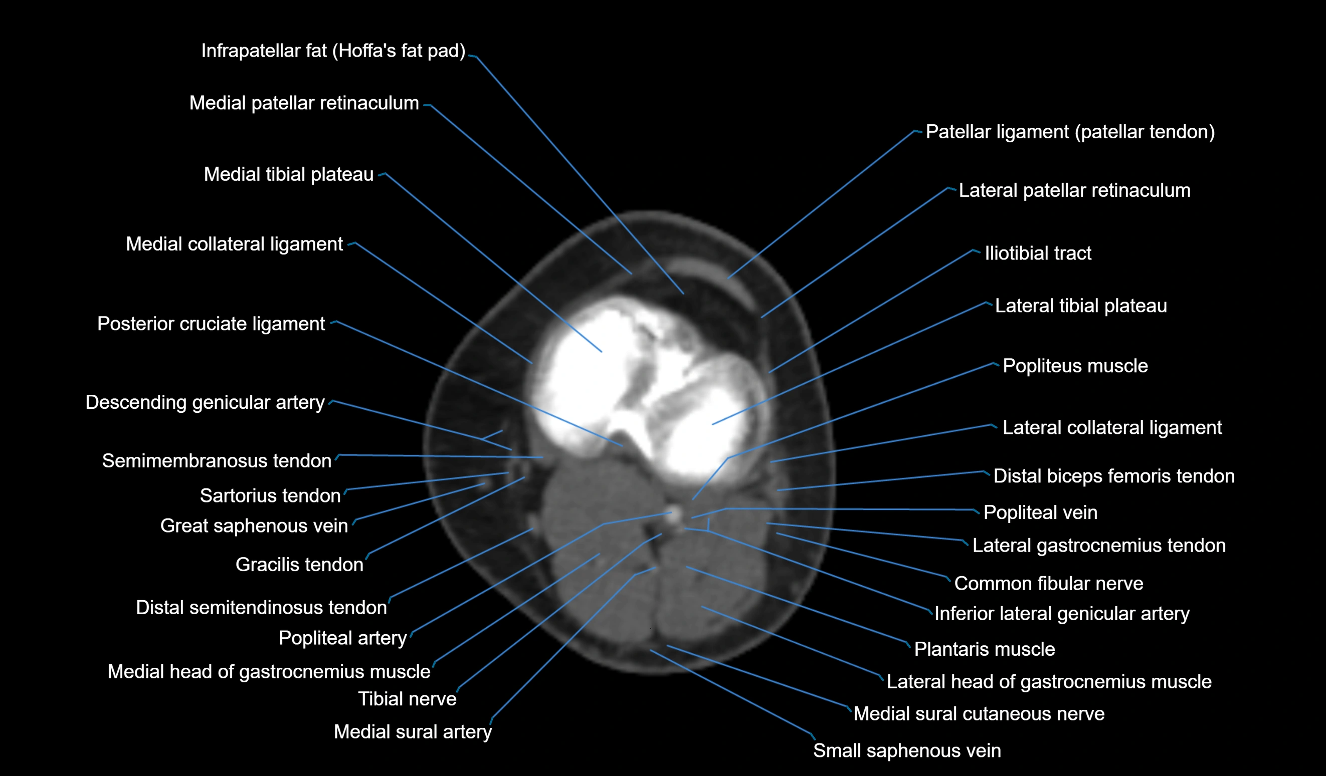 CT knee axial cross sectional anatomy labelled image-00038.webp